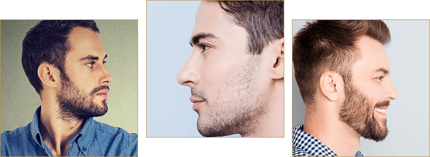 Rhinoplasty for men