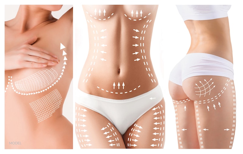 Multi-angle image of a woman's body with plastic surgery lines drawn on it, includes the breasts, abdomen, and butt. 