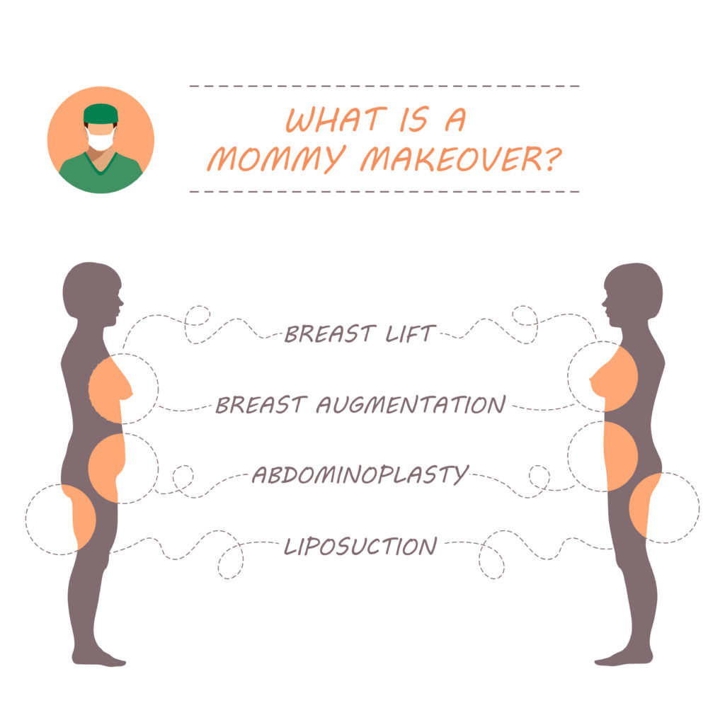 Vector illustration demonstrating the four most common plastic surgery procedures included in a Mommy Makeover.