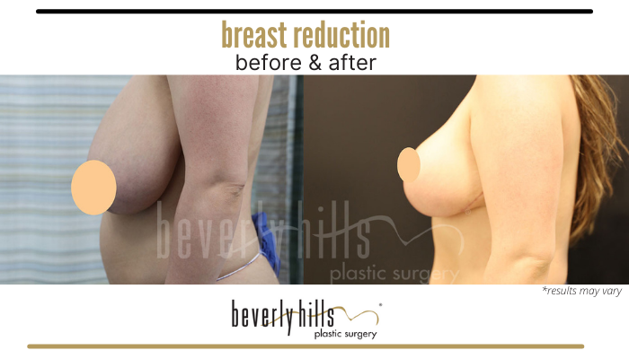 Before and after image showing the results of a breast reduction performed in Beverly Hills, California.
