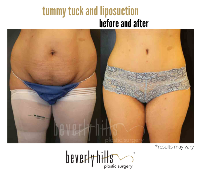 Before and after image showing the results of a tummy tuck and liposuction performed in Beverly Hills, CA.