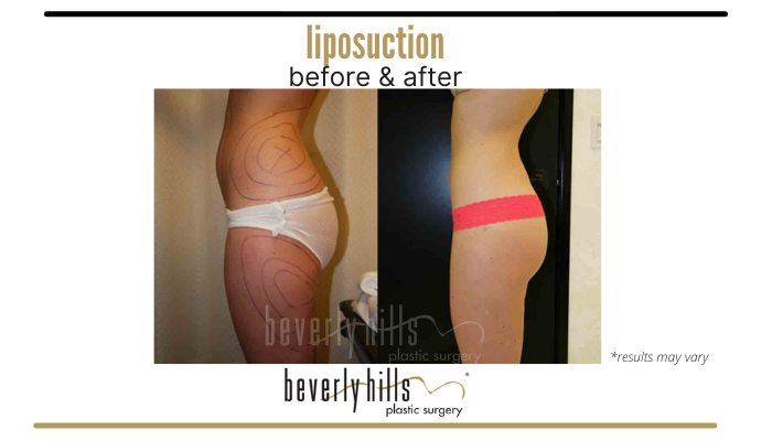 Before and after of a liposuction of the abdomen, waist, flanks, and thighs performed in Beverly Hills, CA.