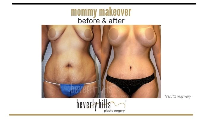 Before and after image showing the results of a Mommy Makeover performed in Beverly Hills, CA.