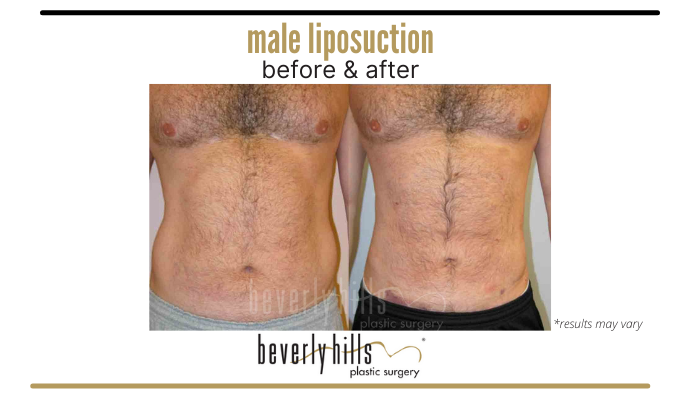 Before and after image showing the results of male liposuction performed in Beverly Hills, CA