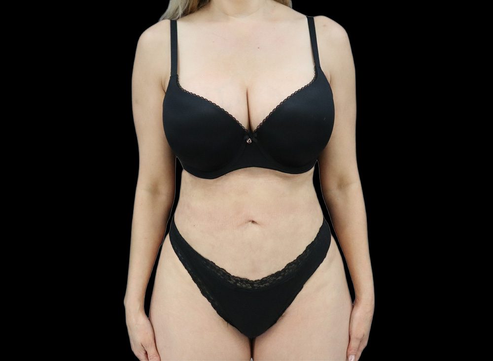 Liposuction Patient After - 2