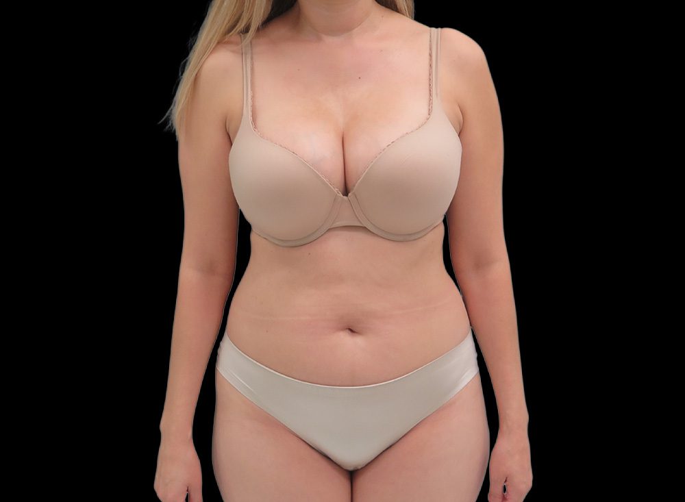 Liposuction Patient Before - 2
