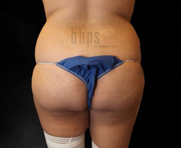Brazilian Butt Lift Patient Before - 2