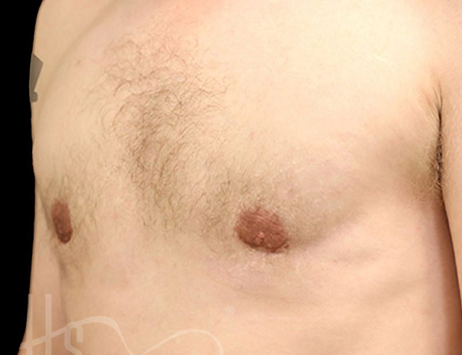 Gynecomastia Patient After - 2