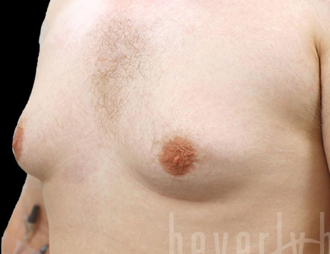 Gynecomastia Patient Before - 2