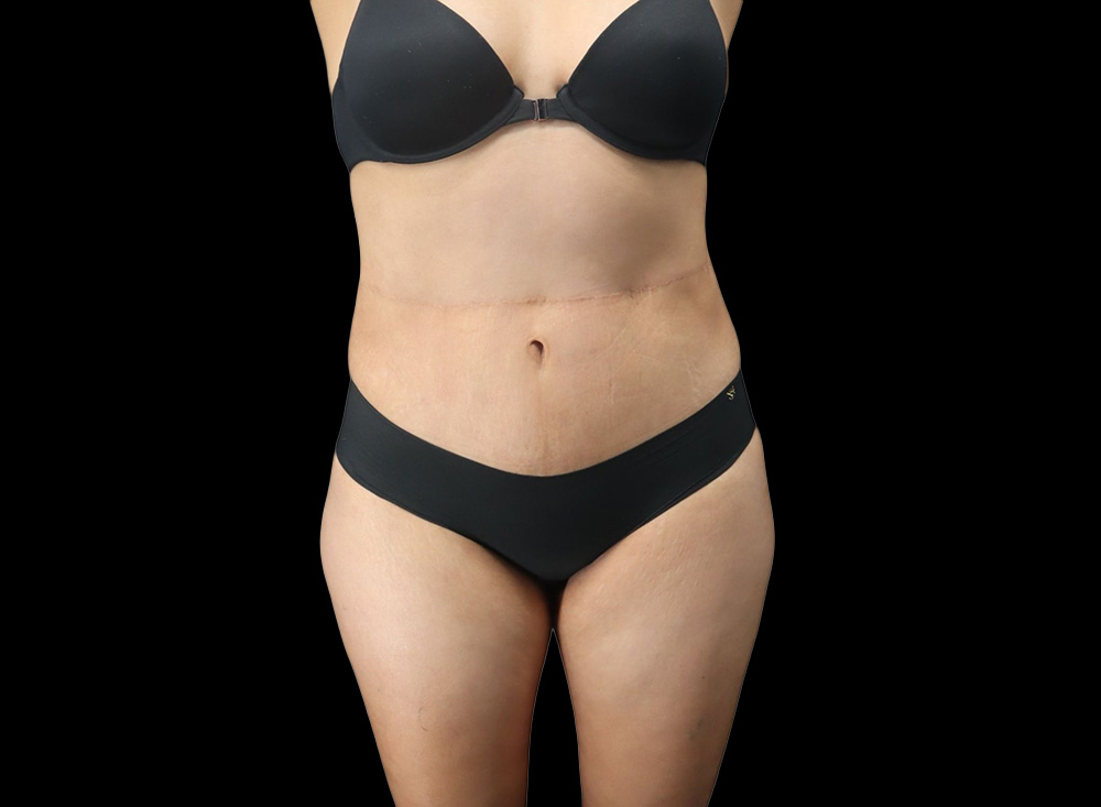 Case--7215 | After Liposuction