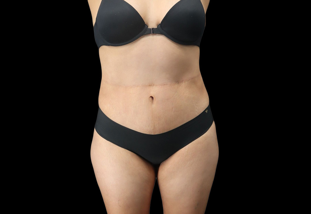 Case--6573 | After Abdominoplasty