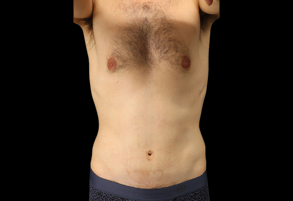 Case--2041 | After Abdominoplasty