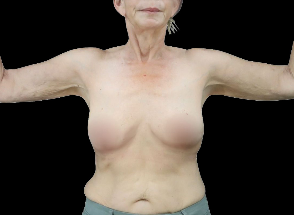 Case--8957 | After Liposuction