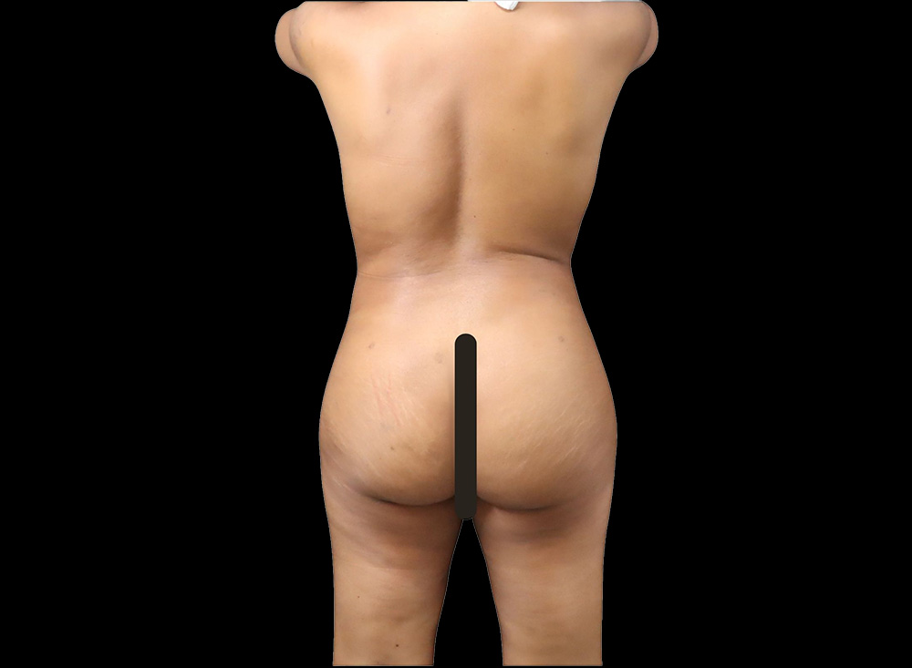 Case--5115 | After Butt Augmentation