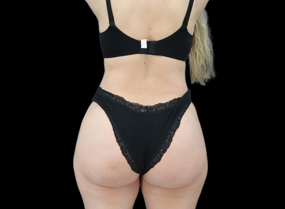 Case--1557 | After Butt Augmentation