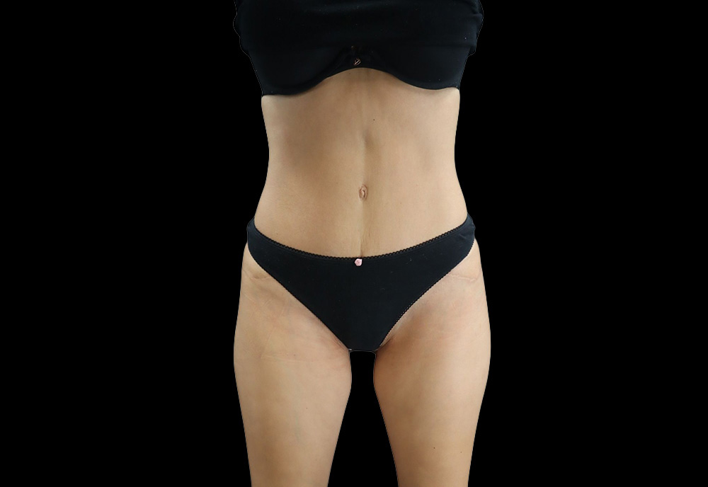 Case--3466 | After Abdominoplasty