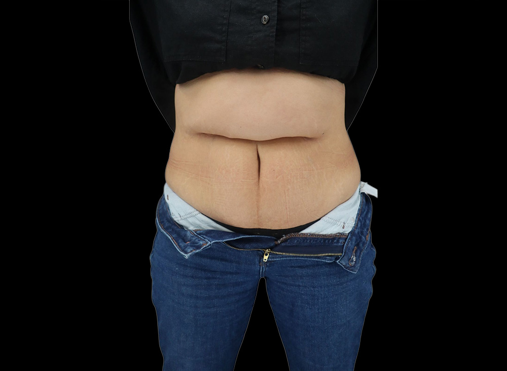 Case--7215 | Before Liposuction