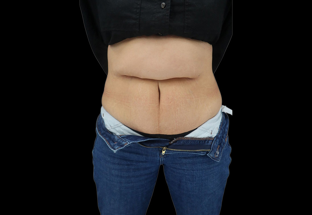 Case--6573 | Before Abdominoplasty
