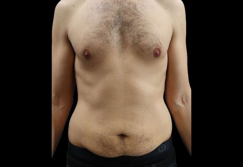 Case--2041 | Before Abdominoplasty