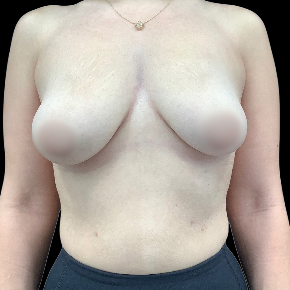 Case--1597 | Before Mastopexy