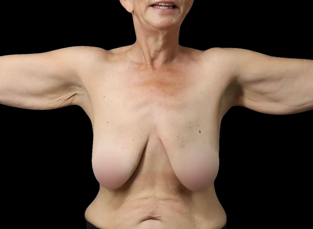 Case--8957 | Before Liposuction