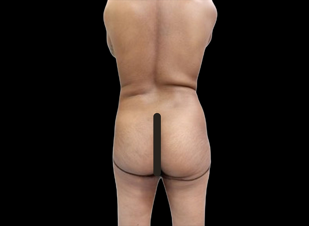 Case--5115 | Before Butt Augmentation