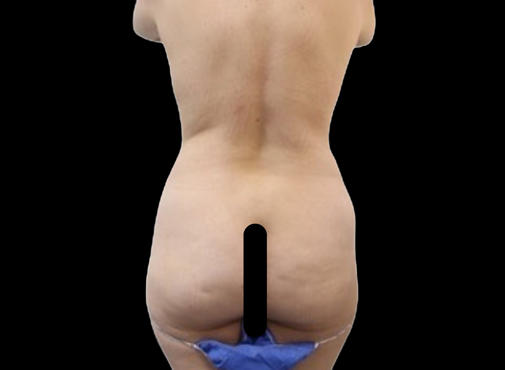 Case--1557 | Before Butt Augmentation