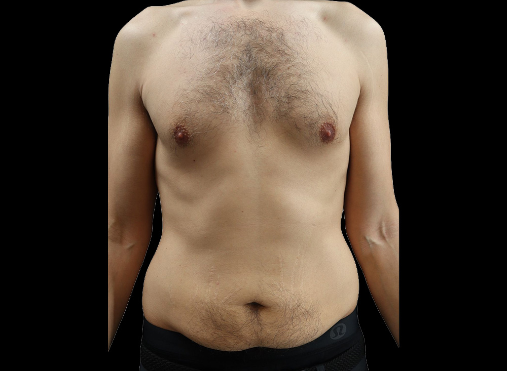 Case--2739 | Before Liposuction