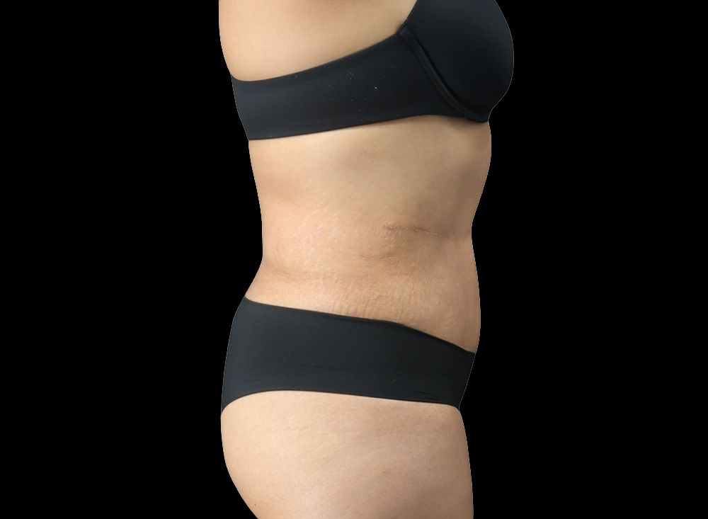 Case--7215 | After Liposuction 2