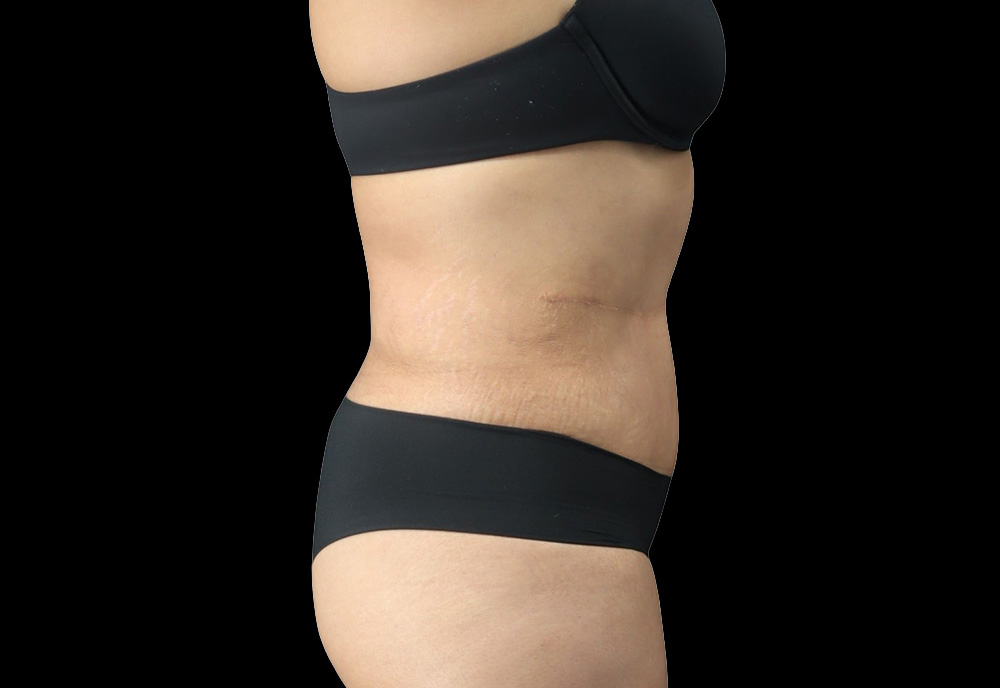 Case--6573 | After Abdominoplasty 2
