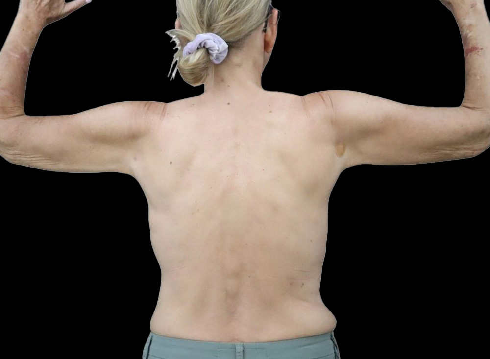 Case--8957 | After Liposuction 2