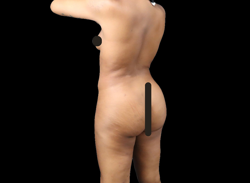 Case--5115 | After Butt Augmentation 2