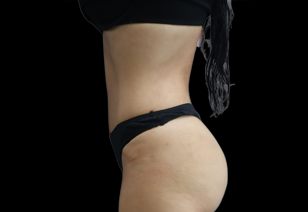 Case--3466 | After Abdominoplasty 2