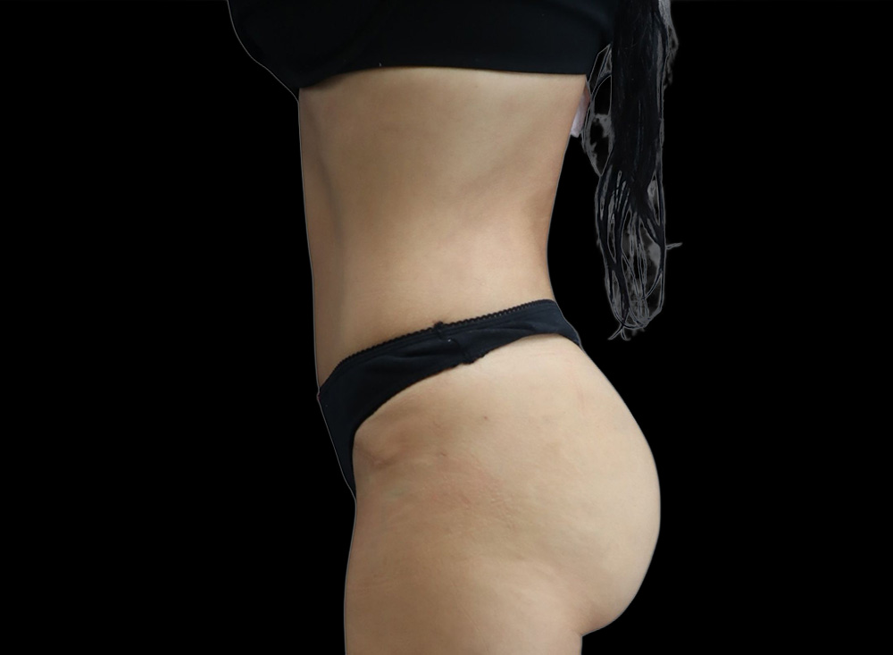 Case--4616 | After Liposuction 2