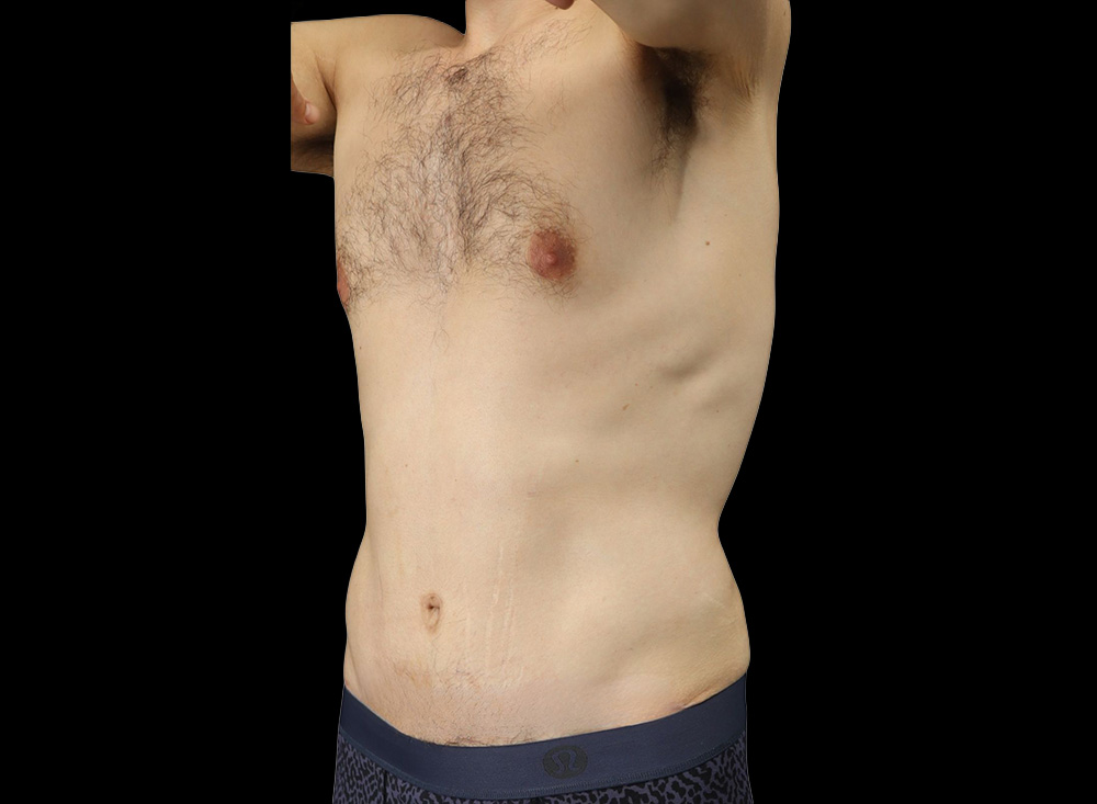 Case--2739 | After Liposuction 2