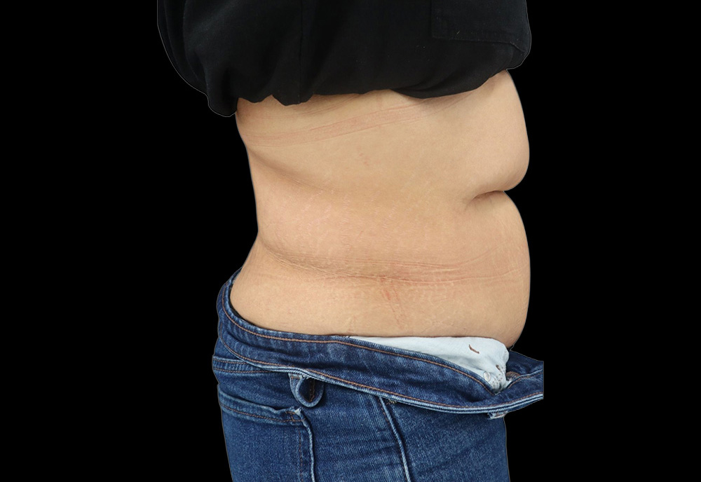 Case--6573 | Before Abdominoplasty 2