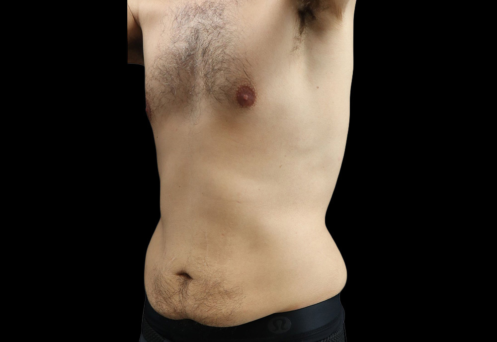 Case--2041 | Before Abdominoplasty 2