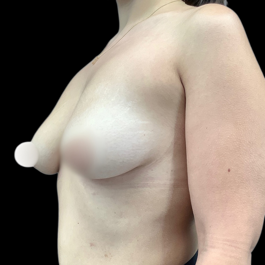 Case--1597 | Before Mastopexy 2