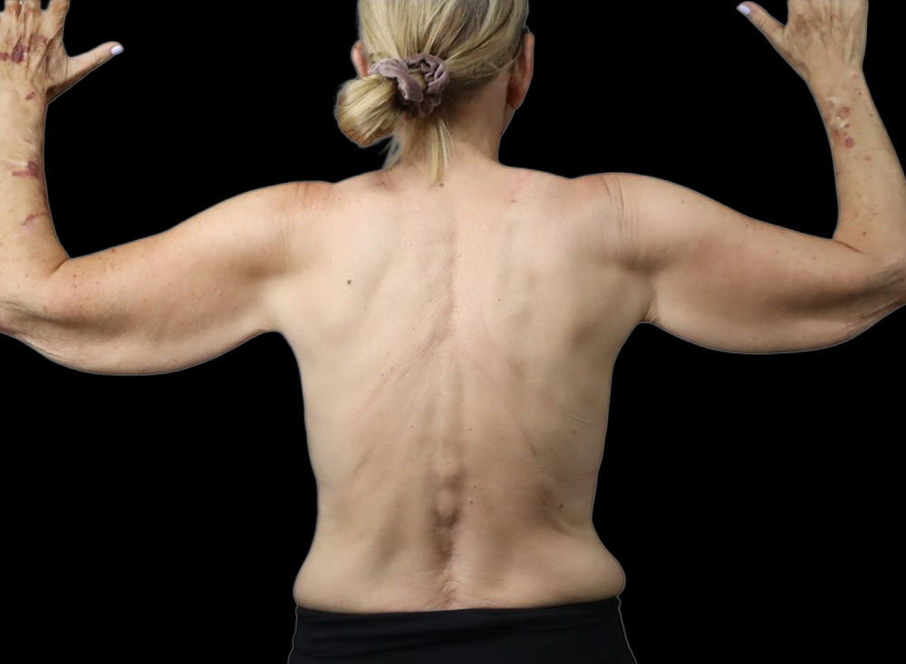 Case--8957 | Before Liposuction 2