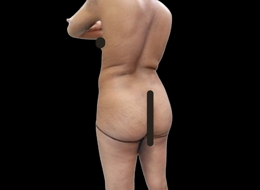 Case--5115 | Before Butt Augmentation 2