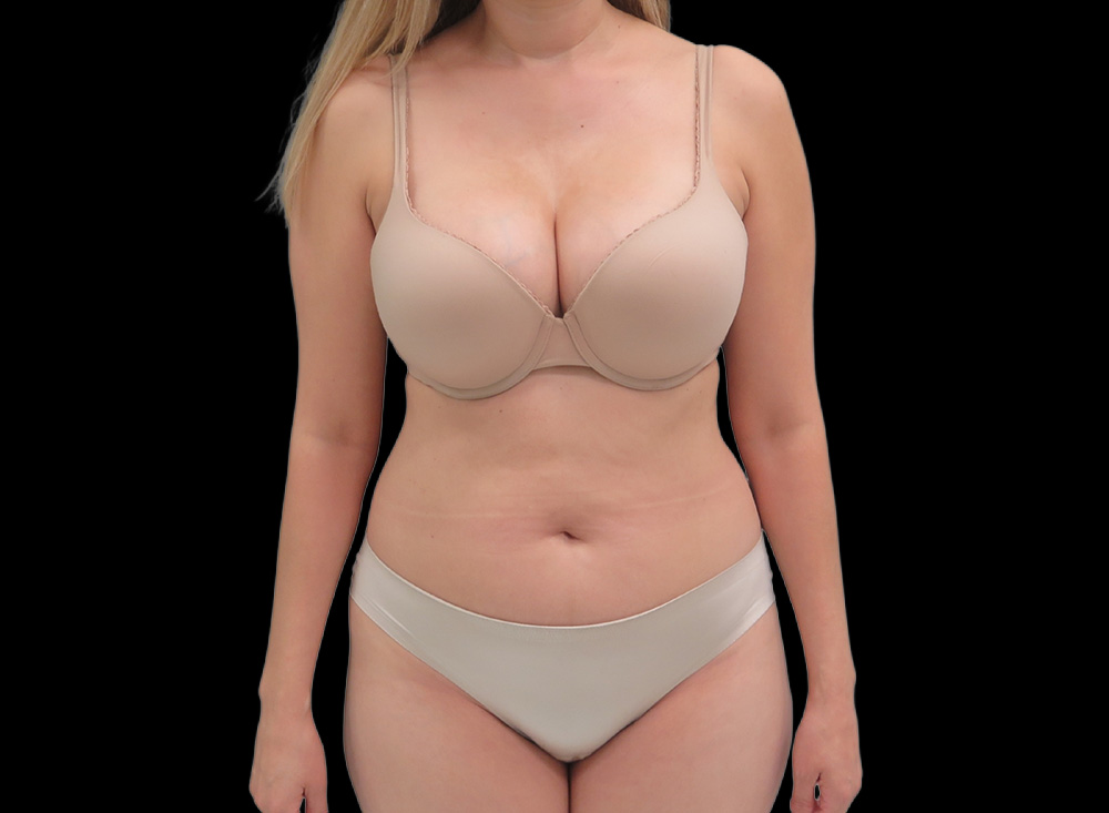 Case--9566 | Before Liposuction