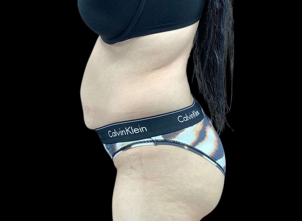 Case--4616 | Before Liposuction 2