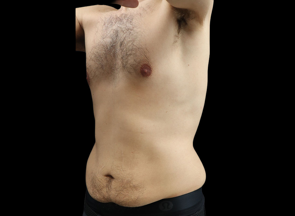 Case--2739 | Before Liposuction 2