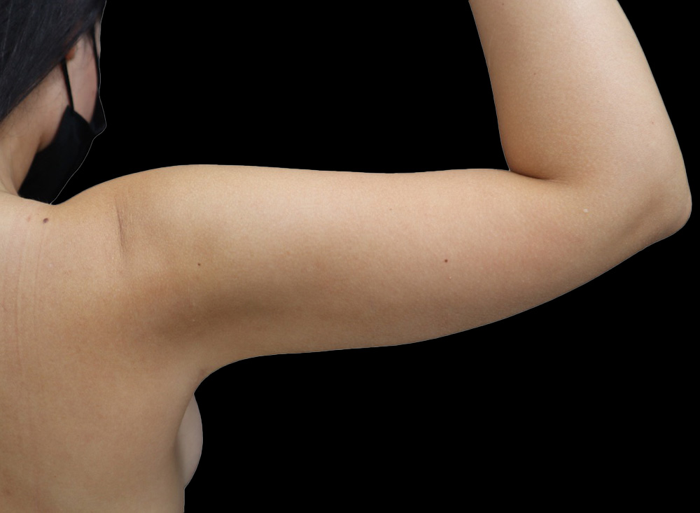 Case--1777 | After Liposuction 3