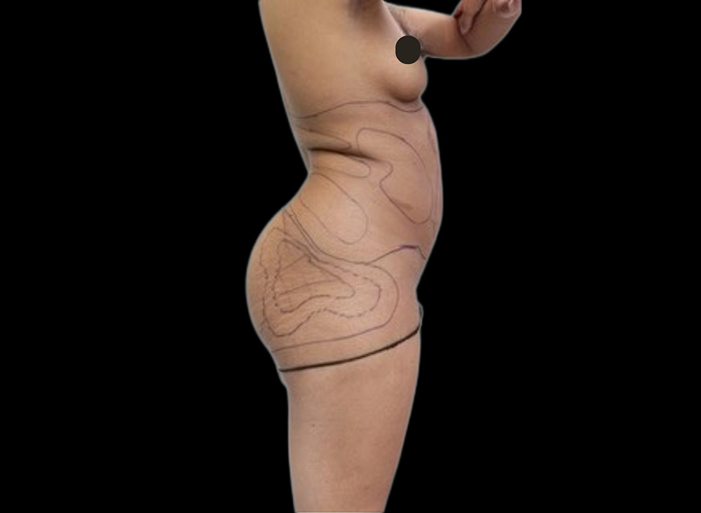 Case--6174 | Before Liposuction