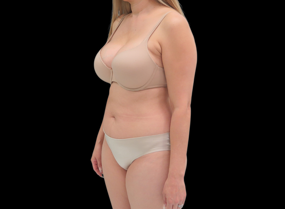 Case--9566 | Before Liposuction 2