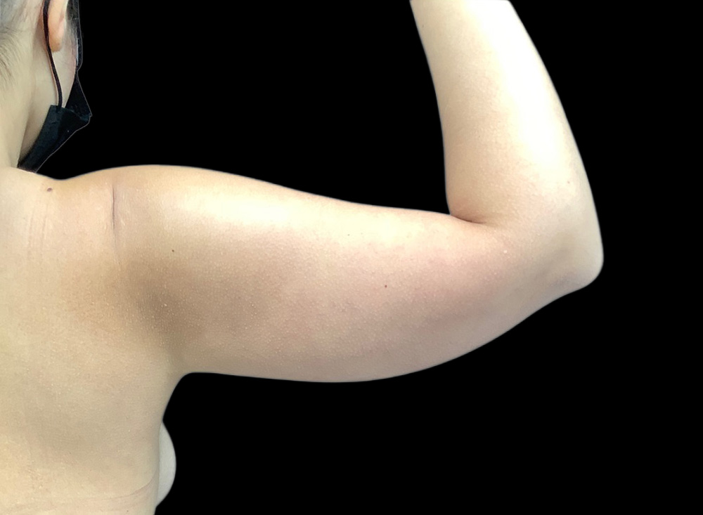 Case--1777 | Before Liposuction 3