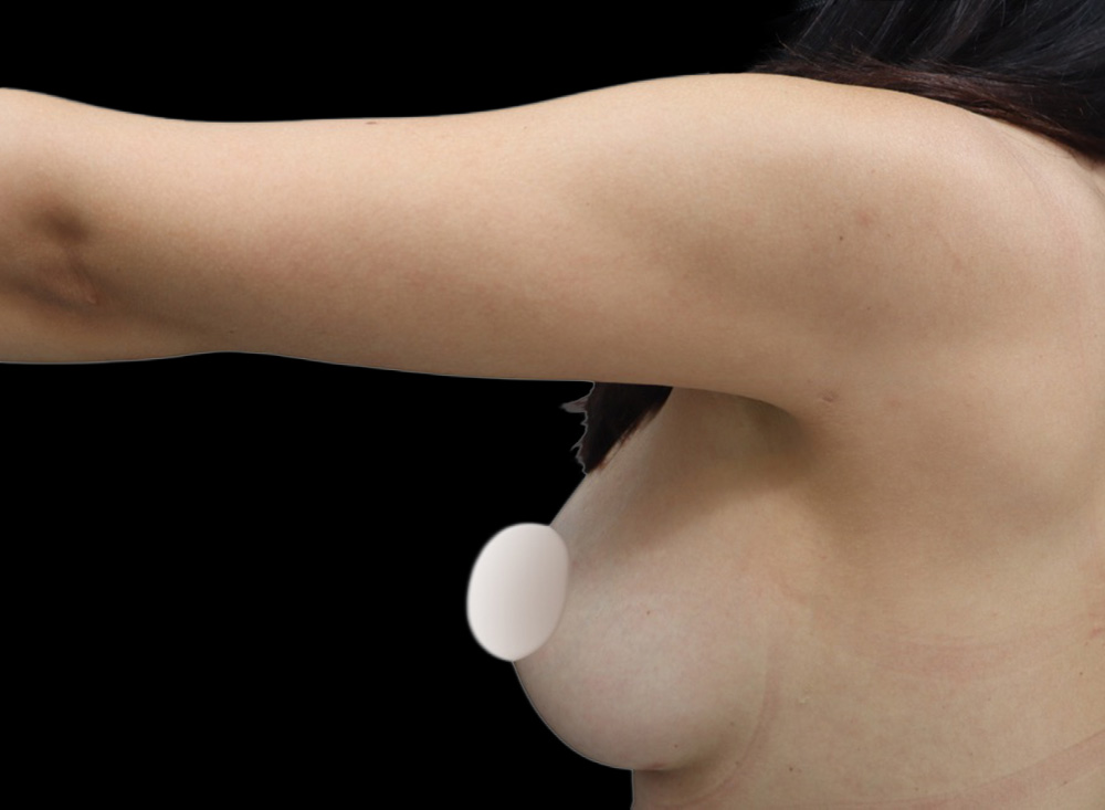 Case--1777 | After Liposuction 4