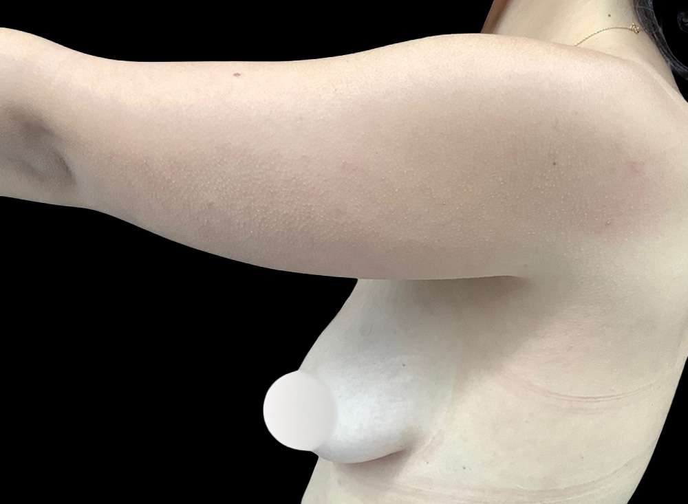 Case--1777 | Before Liposuction 4