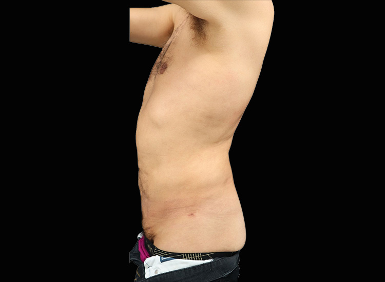 Case--6824 | After Liposuction 2